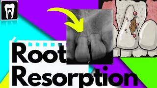 Root ResorptionTypes of Resorption Internal or External Root ResorptionRadiographic Interpretation [upl. by Nimoynib]