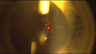 YAG LASER Capsulotomy for Post Cataract Posterior Capsular Fibrosis [upl. by Denney]