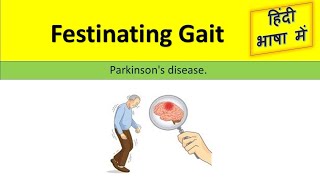 Festinating gait  Parkinsons disease  Easy and Short Video  Hindi Language [upl. by Caryn]