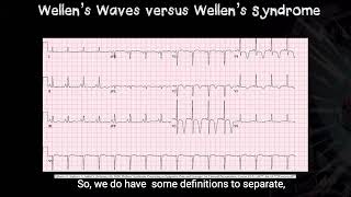 Wellens Wave vs Wellens Syndrome  Good Reads 32024 [upl. by Adnuahsal911]