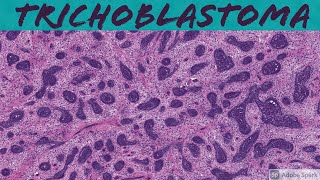 Trichoblastoma 5Minute Pathology Pearls [upl. by Conah143]