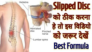 L4 L5 S1 Slipped Disc Treatment  Best Formula For Slipped Disc Treatment  In Hindi [upl. by Airdnahc]