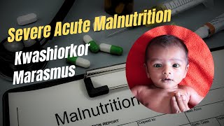 Severe Acute Malnutrition Kwashiorkor Marasmus Protein Energy Malnutrition Robbins Chapter 8 [upl. by Acinet773]