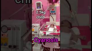 Cyanosis On the cpap😳😱newborn nicu baby shorts ytshorts cpap childvideo newbornill [upl. by Aizan]