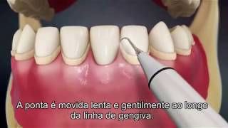 Destartarização Limpeza Dentária [upl. by Anippesuig952]