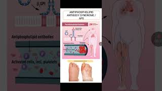 Antiphospholipid Antibody Syndrome [upl. by Enidlarej]