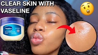 I USED VASELINE ON MY FACE EVERYDAY FOR ONE WEEK AND IM SHOOK😳😳  SLUGGING to get clear skin [upl. by Fairley]