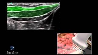 How To Ilioinguinal and Iliohypogastric Regional Nerve Block 3D Video [upl. by Mosra154]