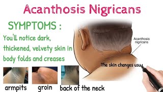 Acanthosis Nigricans  SymptomsCausesRisk Factors ComplicationsTreatment [upl. by Esimaj]