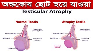 টেস্টিকুলার এট্রোপি কি অন্ডকোষ ছোট হয়ে যাওয়ার কারনলক্ষন ও চিকিৎসা । Testicular Atrophy bangla [upl. by Ammann]