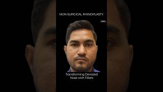 Deviated nose reshaping with non surgical rhinoplasty nonsurgicalrhinoplasty [upl. by Caddric597]