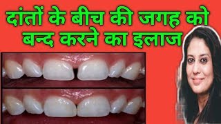 दांतों के बीच में गैप को बंद करने का ईलाजTreatment Of Midline Diastema by Braces [upl. by Klump]