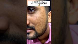 Get Rid Of Acne amp Dark SpotsAcne amp Pigmentation Removal PackGet Spotless Skin ytshortsviralAcne [upl. by Nnylidnarb57]