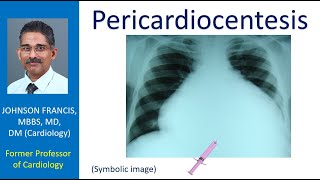 Pericardiocentesis [upl. by Lyle]