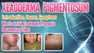 Xeroderma pigmentosum causes symptoms treatment prognosis documentary pronunciation  XP [upl. by Mikahs]