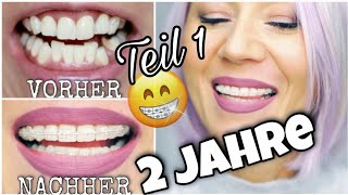 2 JAHRE FESTE ZAHNSPANGE  UPDATE😮 QampA Zahnspange Erwachsene Keramik Brackets WithKat [upl. by Cross]