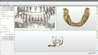 Match the intraoral scan to the CBCT scan step4 [upl. by Adnohsal]