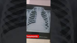 chest xray medical doctors pneumonia youtubeshorts [upl. by Gnov217]