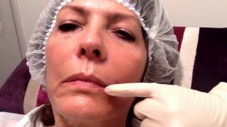 Juvederm Volift to lift Mouth Corners  Outline Clinic Droitwich UK [upl. by Sunev]