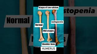 Stages of Calcium in Bone youtubeshorts vitamin d [upl. by Moazami]