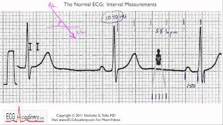 Interval Measurements 64  ECG  EKG Interpretation  BASIC [upl. by Esila]