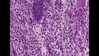 Histopathology Uterus endometriumProliferative endometriu [upl. by Nyleuqaj]