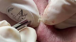 ACNE UNDER THE SKIN  Acne Treatment Mai Ngoc [upl. by Ehrenberg]