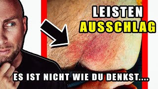 Leisten Hautausschlag  Kein Hautpilz Was ihn triggert amp beeinflusst  neutrophile Dermatose [upl. by Aicenaj221]