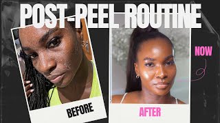 CHEMICAL PEEL  recommended skincare routine after peel  POST CHEMICAL PEEL AFTERCARE [upl. by Eilrahc]