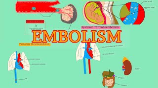 Pathology 18HDD 4  EMBOLISM  Pulmonary thromboembolism  Systemic thromboembolism AfSoomaali [upl. by Cohby]