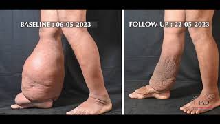 Full Treatment Protocol  Lymphatic Filariasis  IAD India  integrative medicine [upl. by Alekram688]