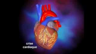 Infarctus du myocarde [upl. by Elleivap]