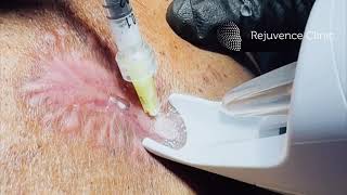 Intralesional steroid injections for keloid scars on the body rejuvenceclinic91 [upl. by Anneis]