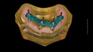 StepbyStep Allon4 Impression Techinique allonX allon4 allon6 fullmouth zygomaticimplants [upl. by Eberly]