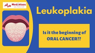 Leukoplakia l Precancerous lesions l Oral pathology l Mediklaas [upl. by Golub]