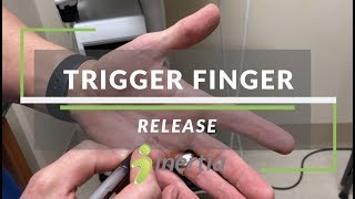 Trigger Finger Release [upl. by Innos327]