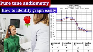 Pure tone Audiometry Graph 📊 🔴conductive hearing loss Sensorineural hearing loss Mixed hearing [upl. by Thistle825]