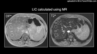 Cardiac and Hepatic Hemosiderosis as Measured by T2MRI [upl. by Chaney]