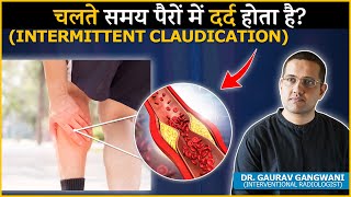 Intermittent Claudication  Symptoms Causes Diagnosis and Treatment Hindi  Dr Gaurav Gangwani [upl. by Aman]