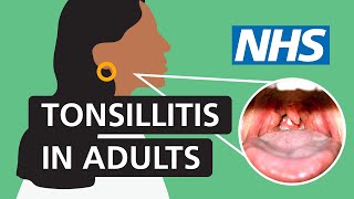 Tonsillitis in adults Symptoms and treatment  NHS [upl. by Odama957]