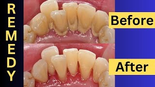 Naturally Remove Dental Plaque At Home Easy Tips And Tricks [upl. by Annaes]