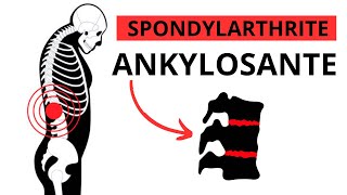 Spondylarthrite Ankylosante  Symptômes Causes Traitement [upl. by Laks756]