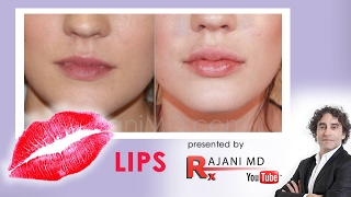 LIP Injections Quick Vid with Dr Rajani [upl. by Ankeny715]