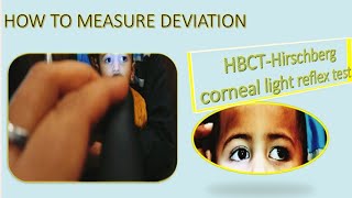 Hirschberg Test Hirschberg Corneal Reflex Test Hirschberg Test Interpretation HBCT Test HBRTCLR [upl. by Eelrak]