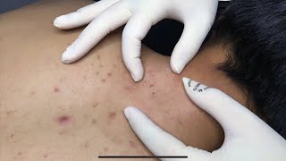 ACNE TREATMENT WITH VU QUYNH MI  Acne on Back amp Chest 2023p1 [upl. by Sachi]