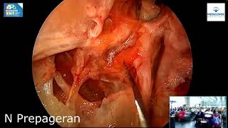 Module 5 Endoscopic Vidian Canal Meckels Cave and Lateral Sphenoid Recess Exposure of Skull Base [upl. by Hilly]