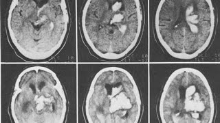 Left thalamic hemorrhagic stroke brain 🧠 hemorrhage  LOC  stroke hypertensive [upl. by Arianne45]