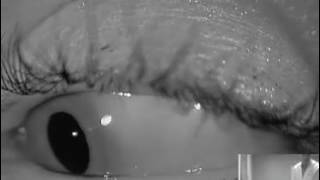 Dramatic Right Posterior Canalithiasis with Gaze Separation [upl. by Alcot436]