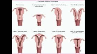 Congenital Uterine Abnormalities  CRASH Medical Review Series [upl. by Edualcnaej]