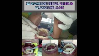 Chronic Periodontitis and Teeth Splinting [upl. by Dnalor703]